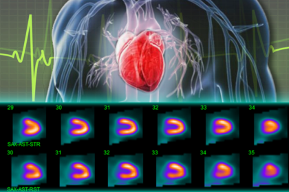 Nuclear Stress Test