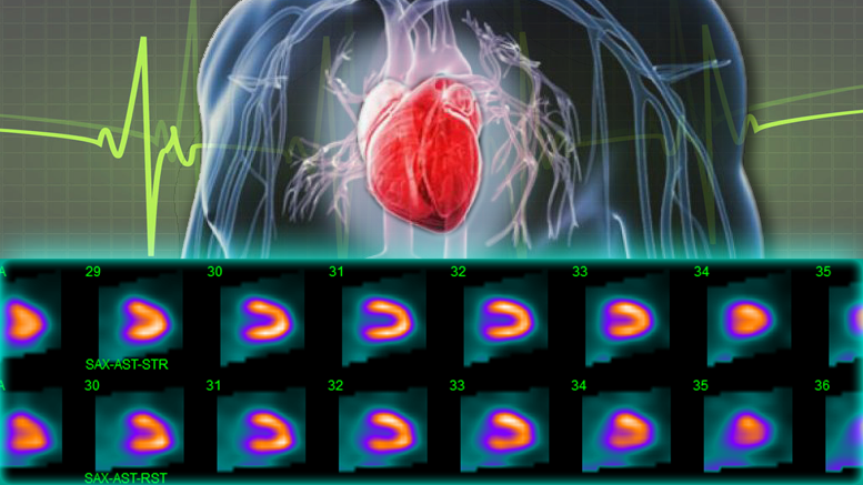 Nuclear Stress Test